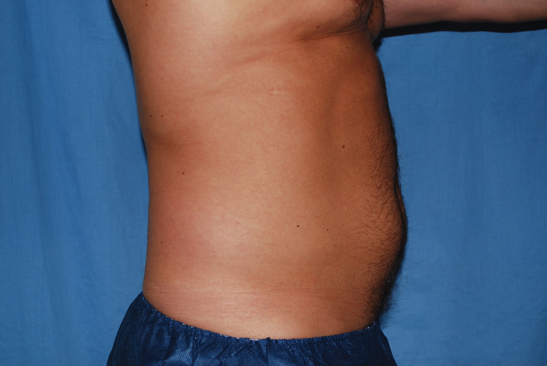 Liposuction Patient Photo - Case 4725 - after view-2