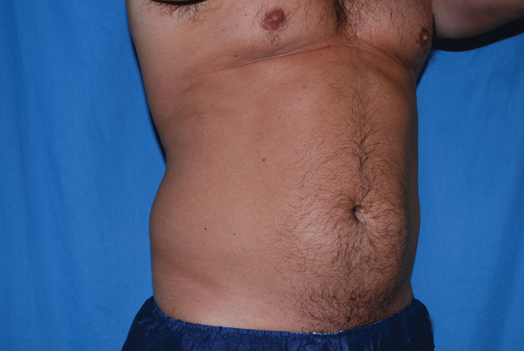 Liposuction Patient Photo - Case 4725 - before view-4