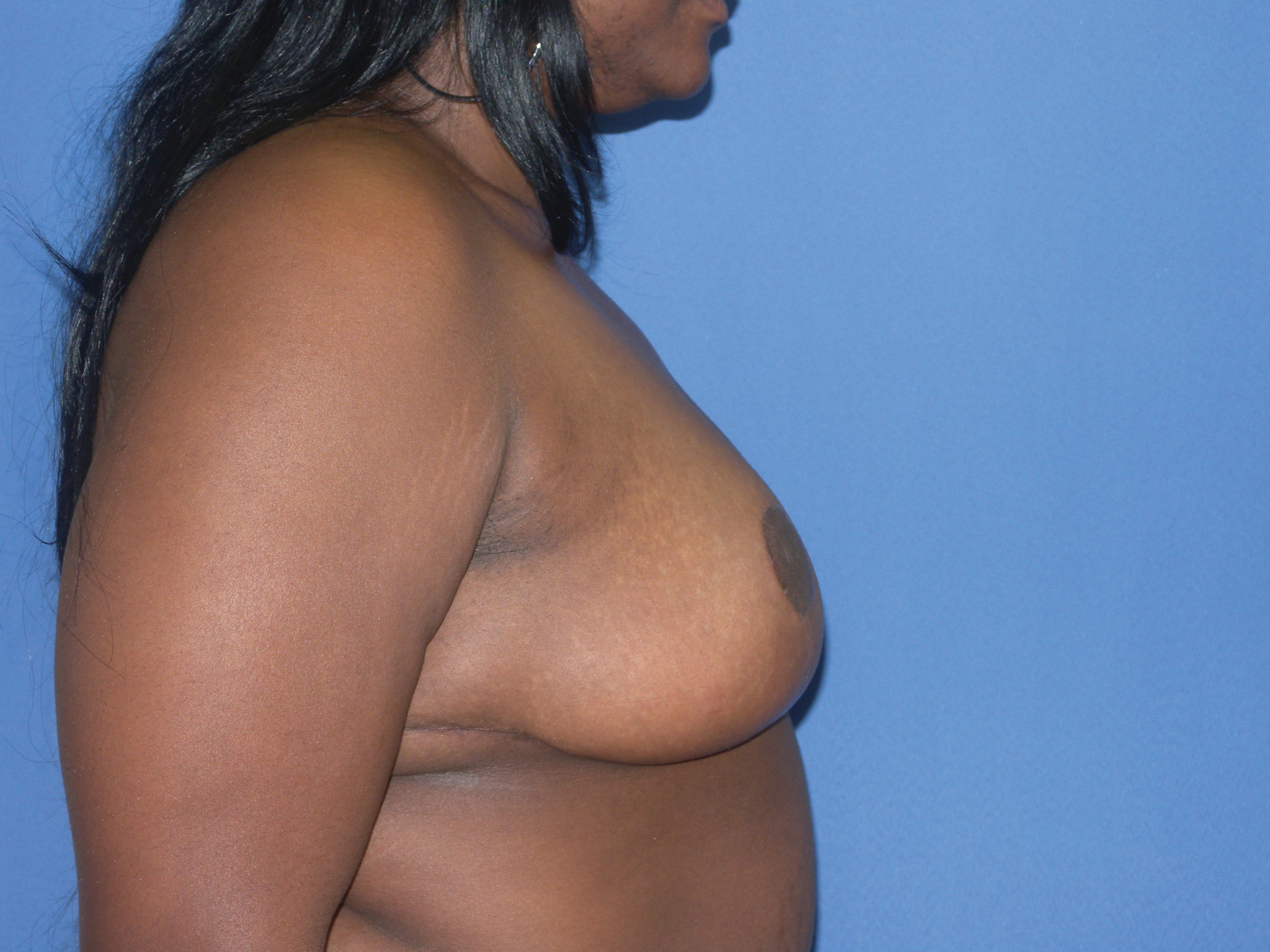Breast Reduction Patient Photo - Case 4581 - after view-1