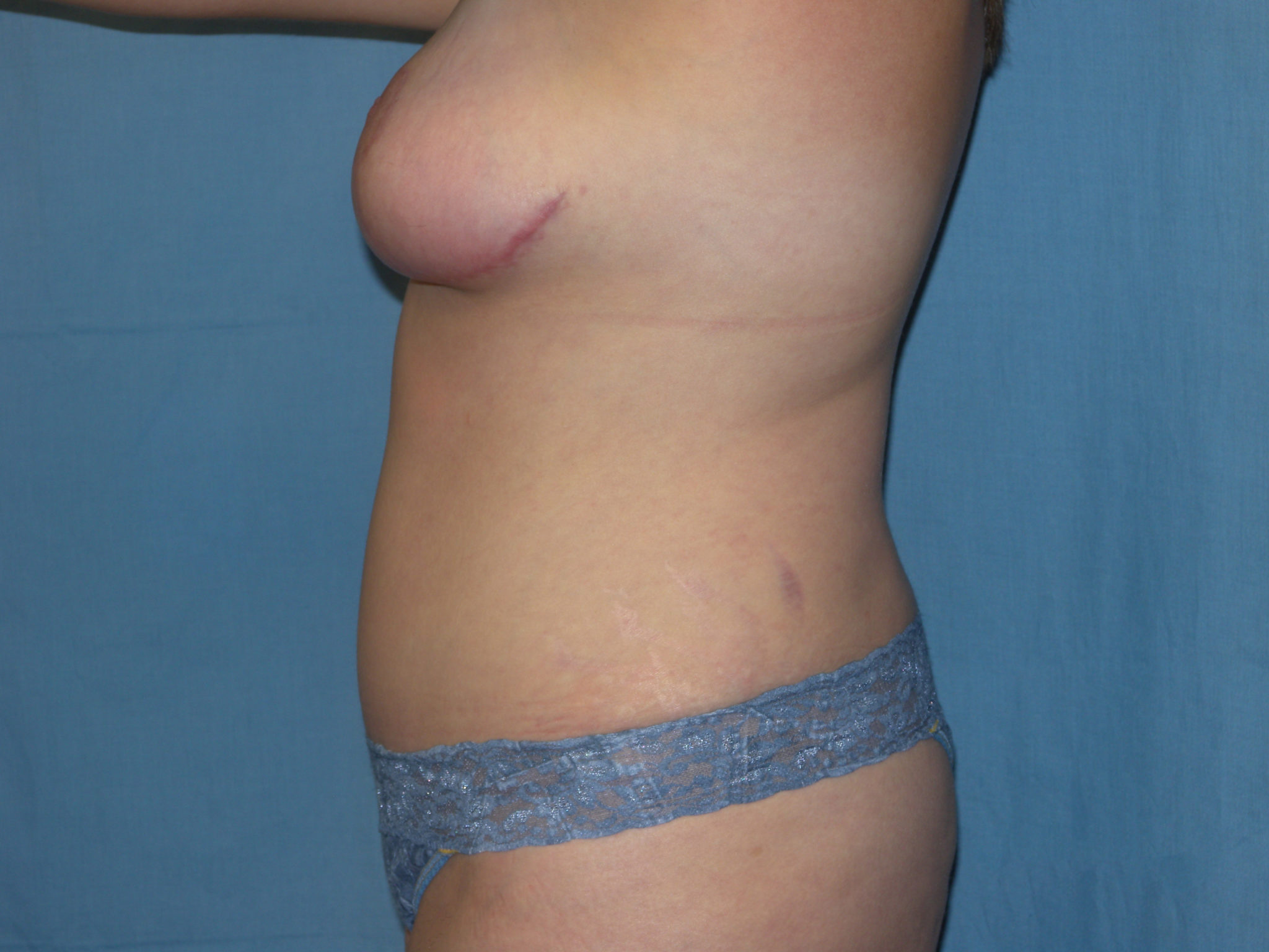 Tummy Tuck Patient Photo - Case 3321 - after view-1