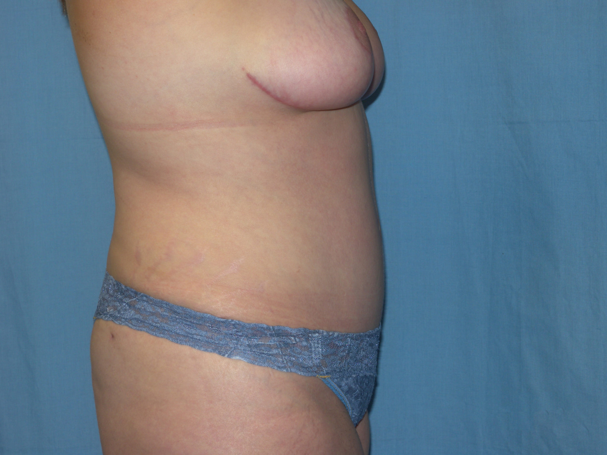 Tummy Tuck Patient Photo - Case 3321 - after view-3
