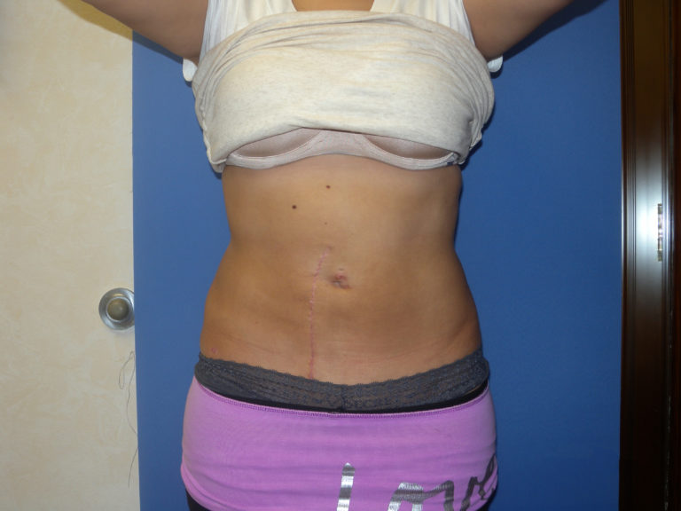 Liposuction - Case 3046 - After