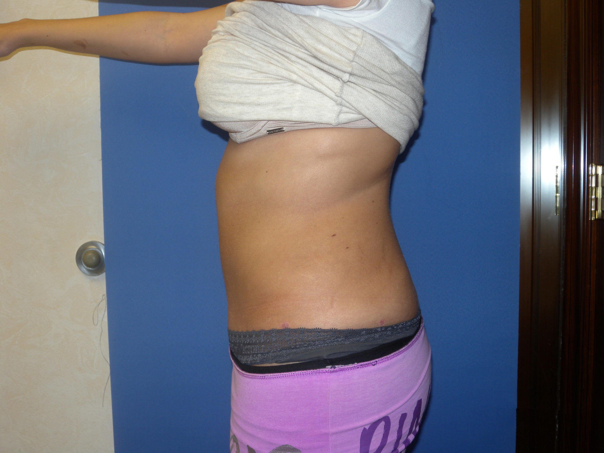 Liposuction Patient Photo - Case 3046 - after view-1