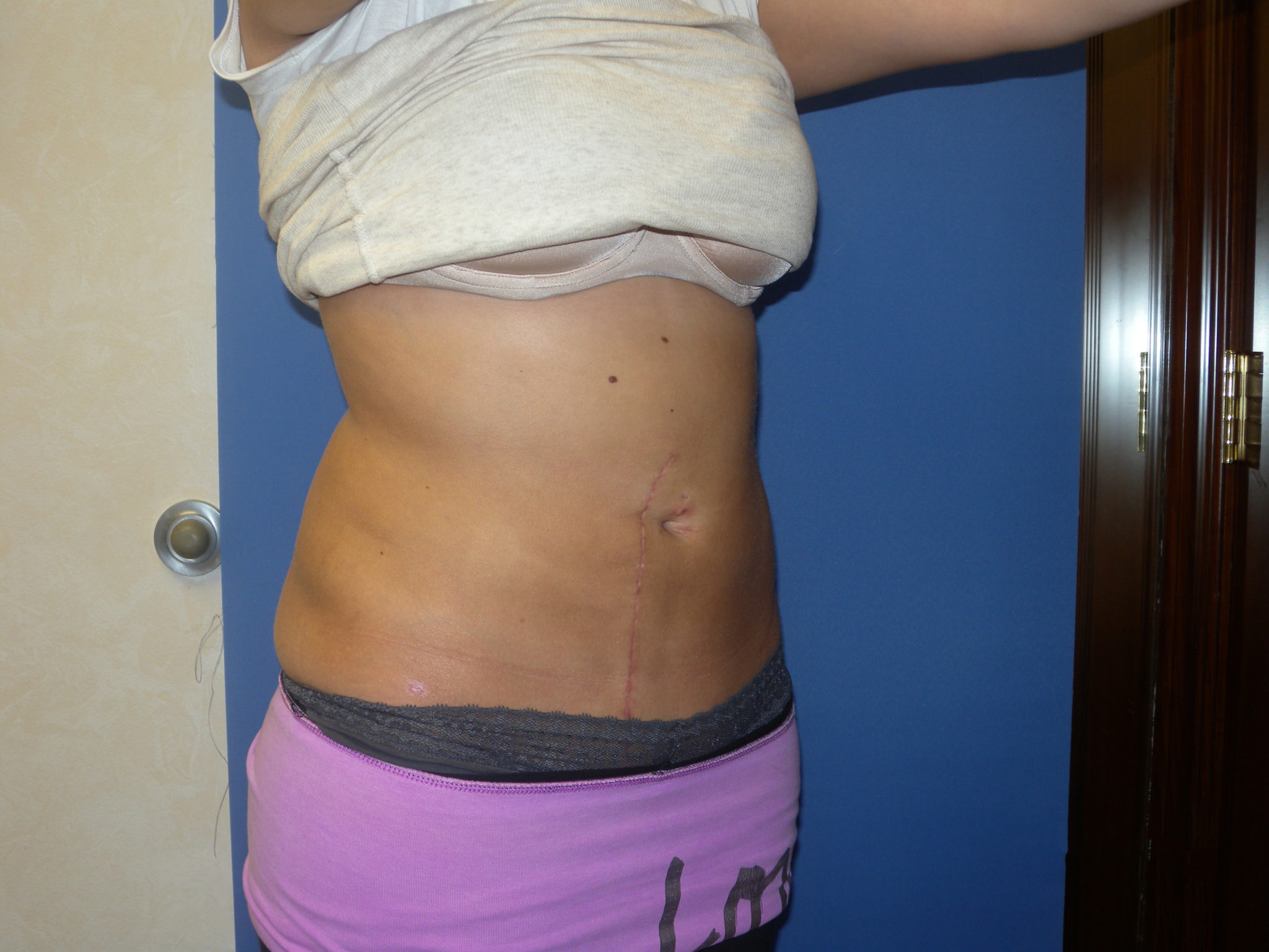 Liposuction Patient Photo - Case 3046 - after view-4