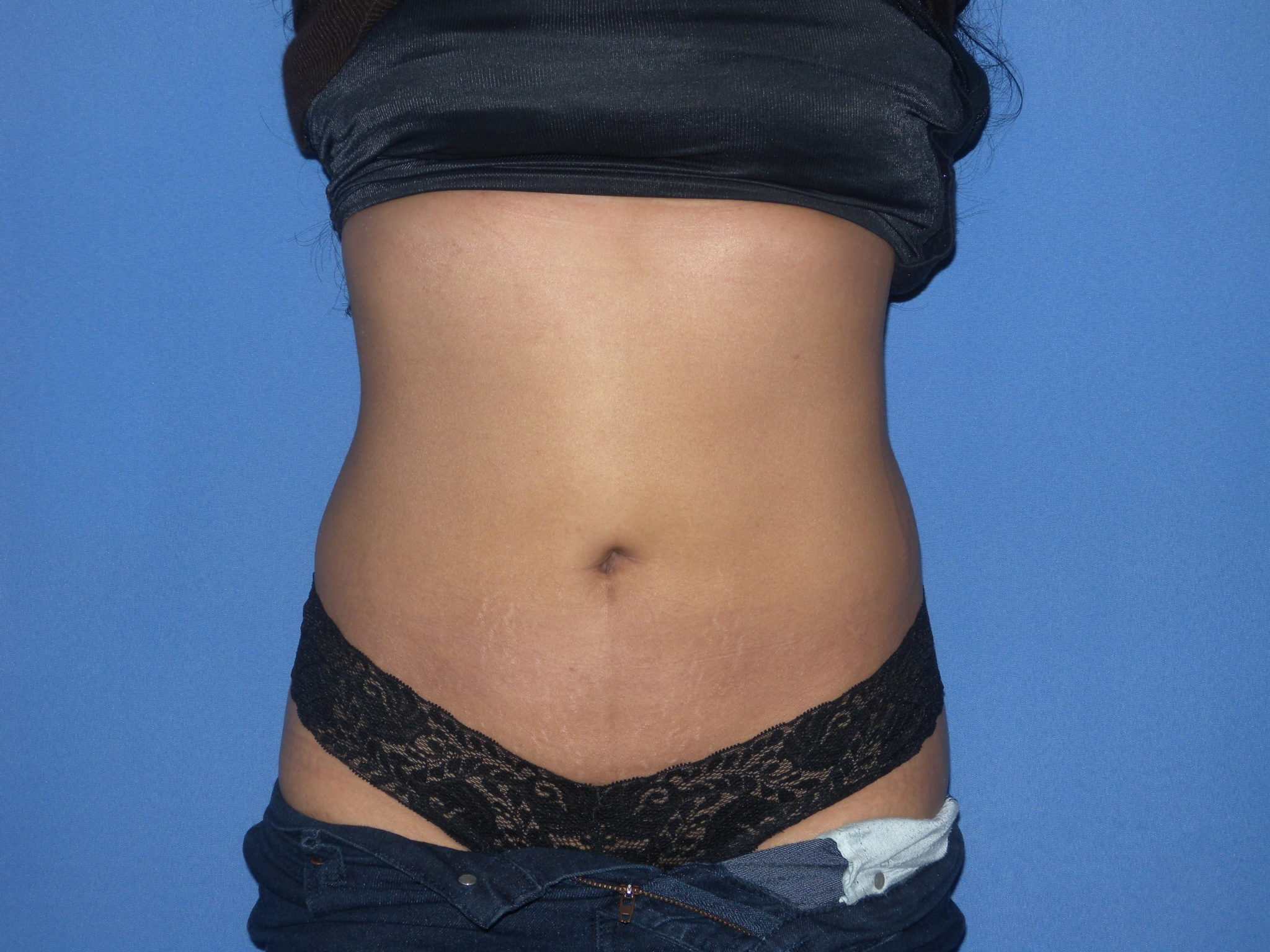 Liposuction Patient Photo - Case 3226 - after view