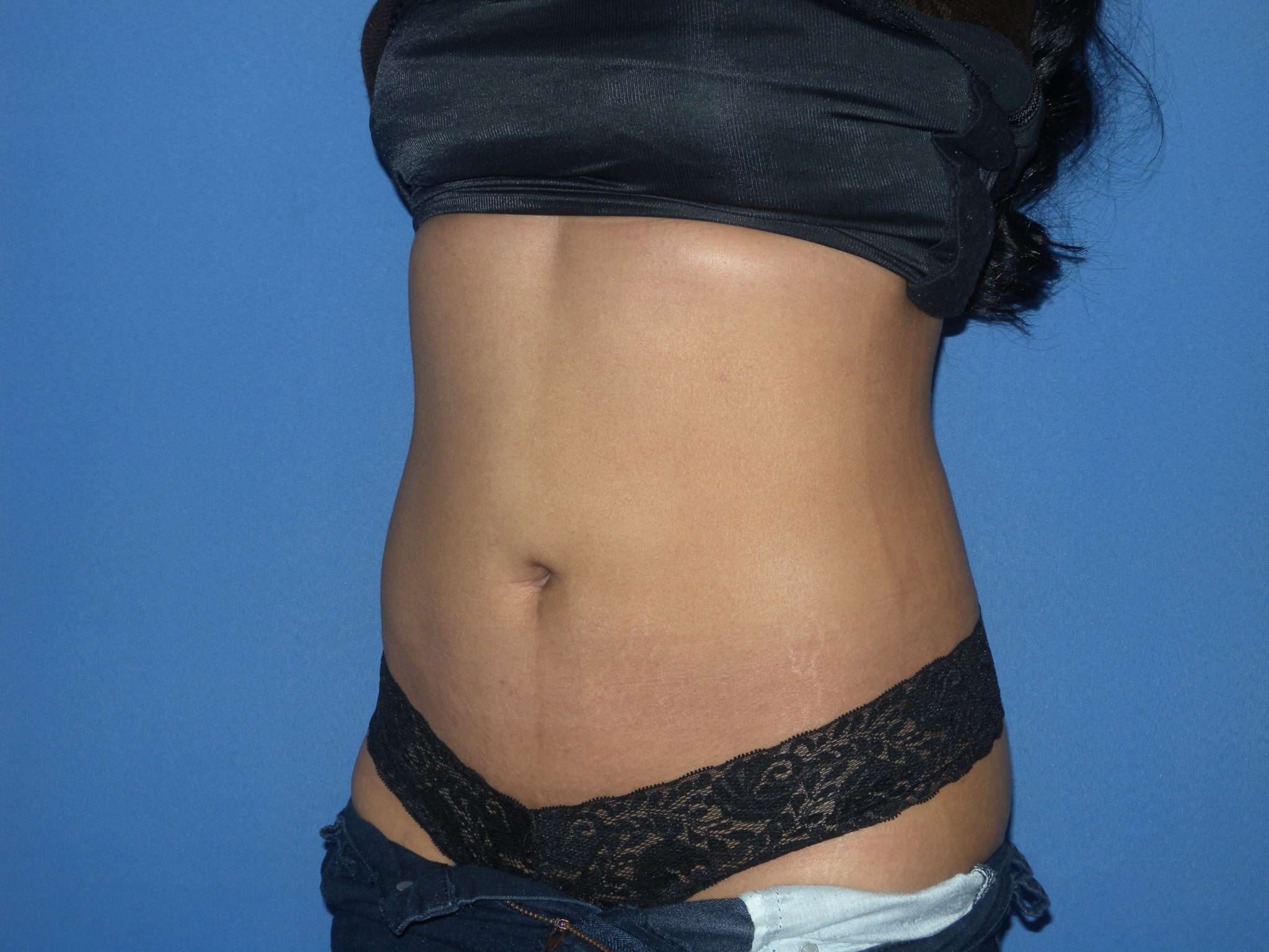 Liposuction Patient Photo - Case 3226 - after view-2