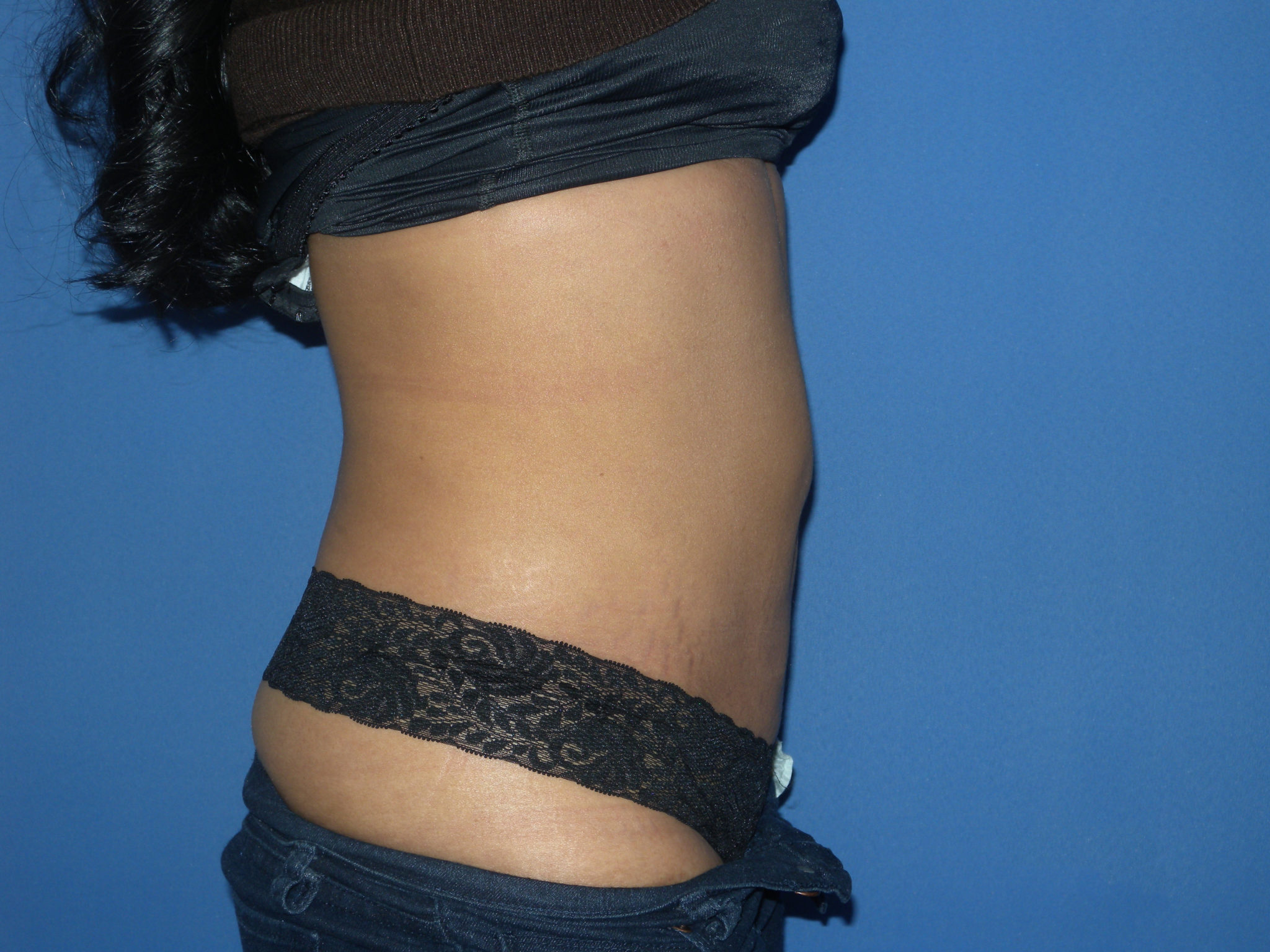 Liposuction Patient Photo - Case 3226 - after view-3