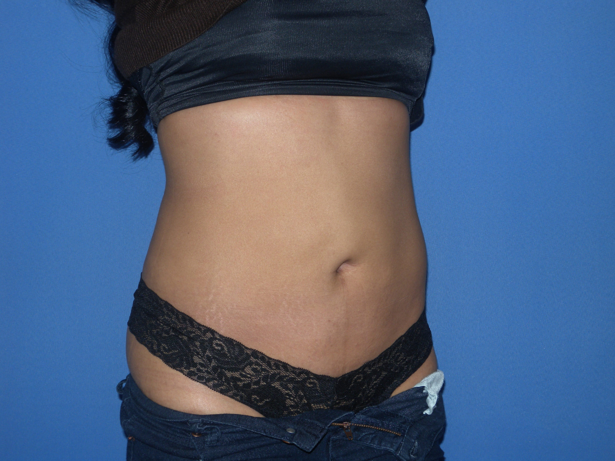 Liposuction Patient Photo - Case 3226 - after view-4