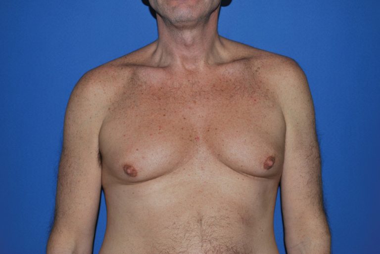 Male Breast Reduction - Case 4920 - Before