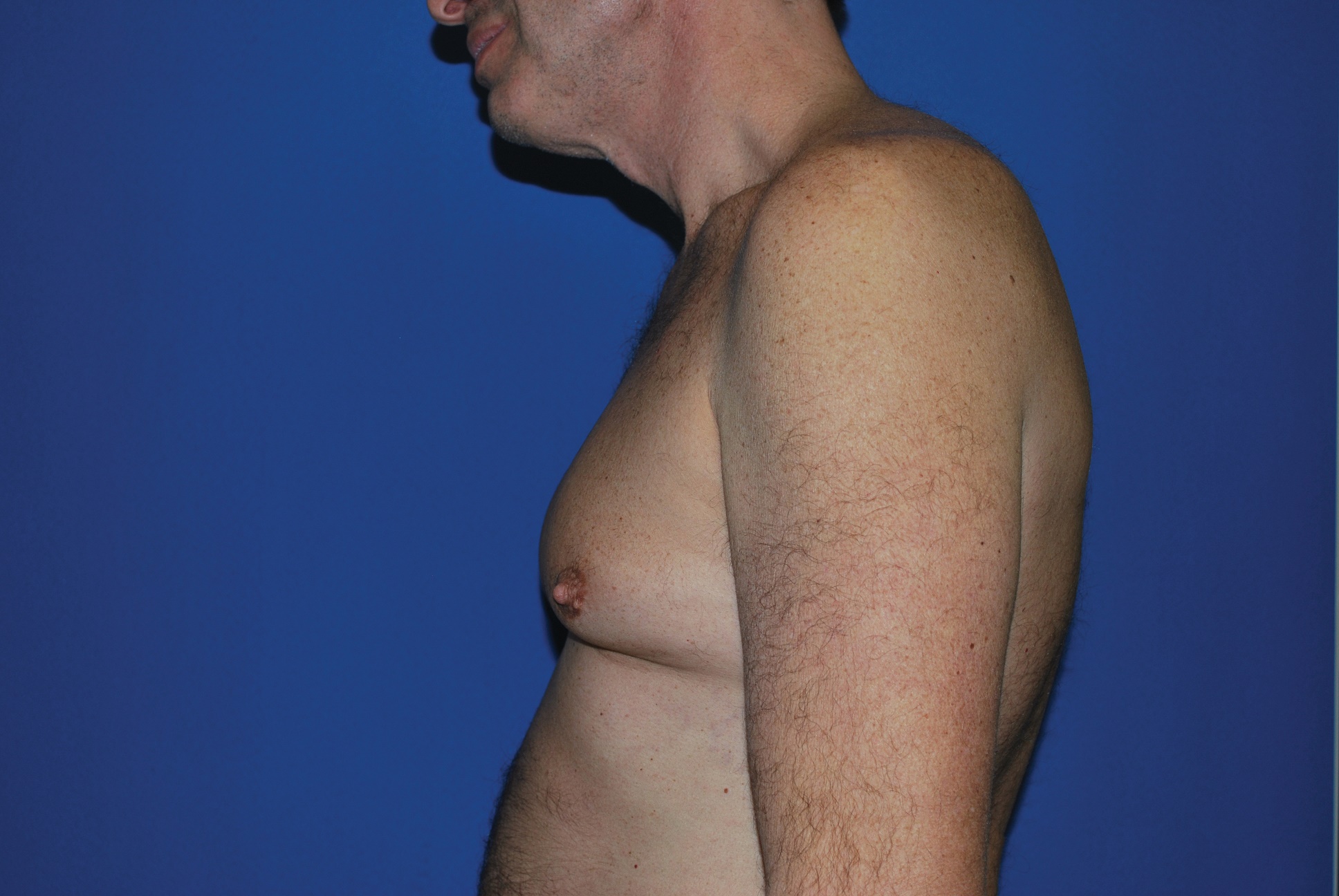 Male Breast Reduction Patient Photo - Case 4920 - before view-4