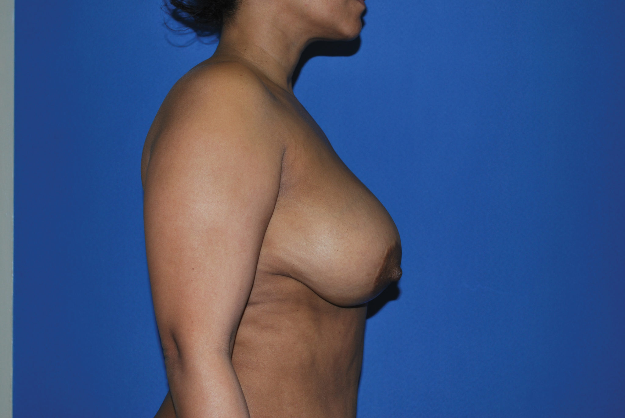 Breast Reduction Patient Photo - Case 4389 - before view-3