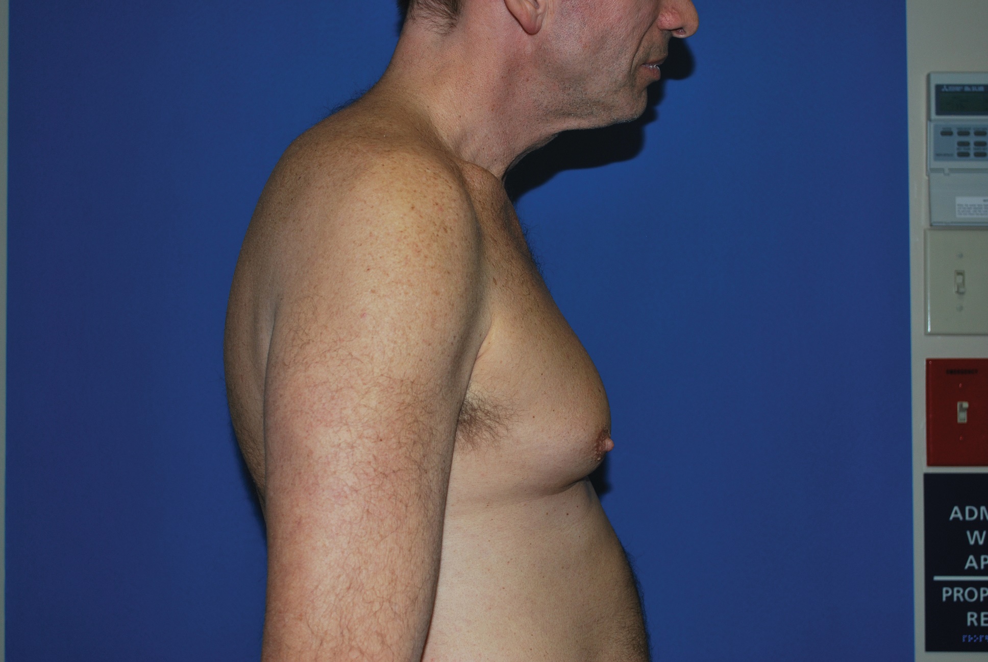 Male Breast Reduction Patient Photo - Case 4920 - before view-2