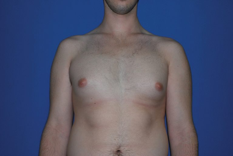 Male Breast Reduction - Case 4897 - Before