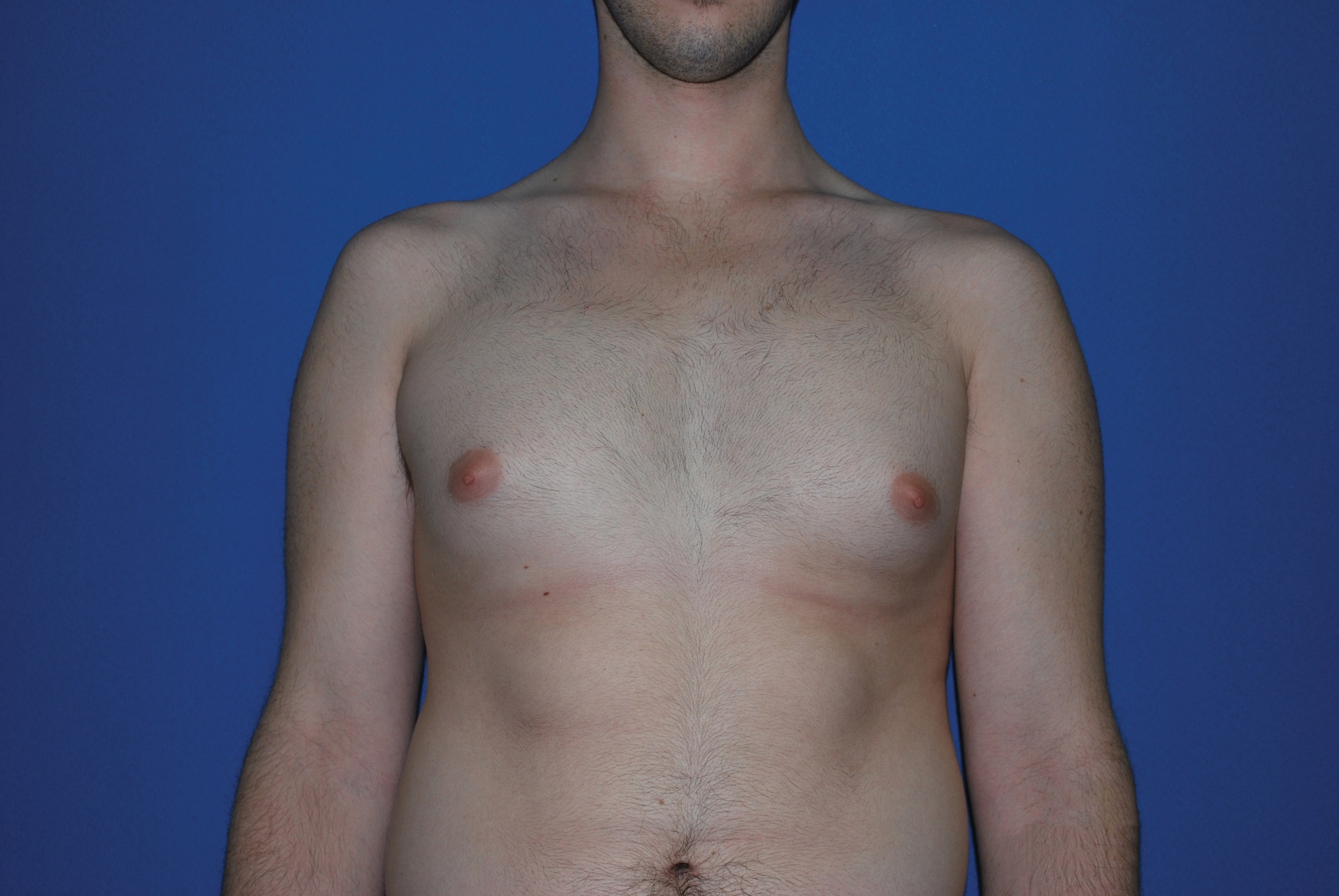 Male Breast Reduction Patient Photo - Case 4897 - before view-