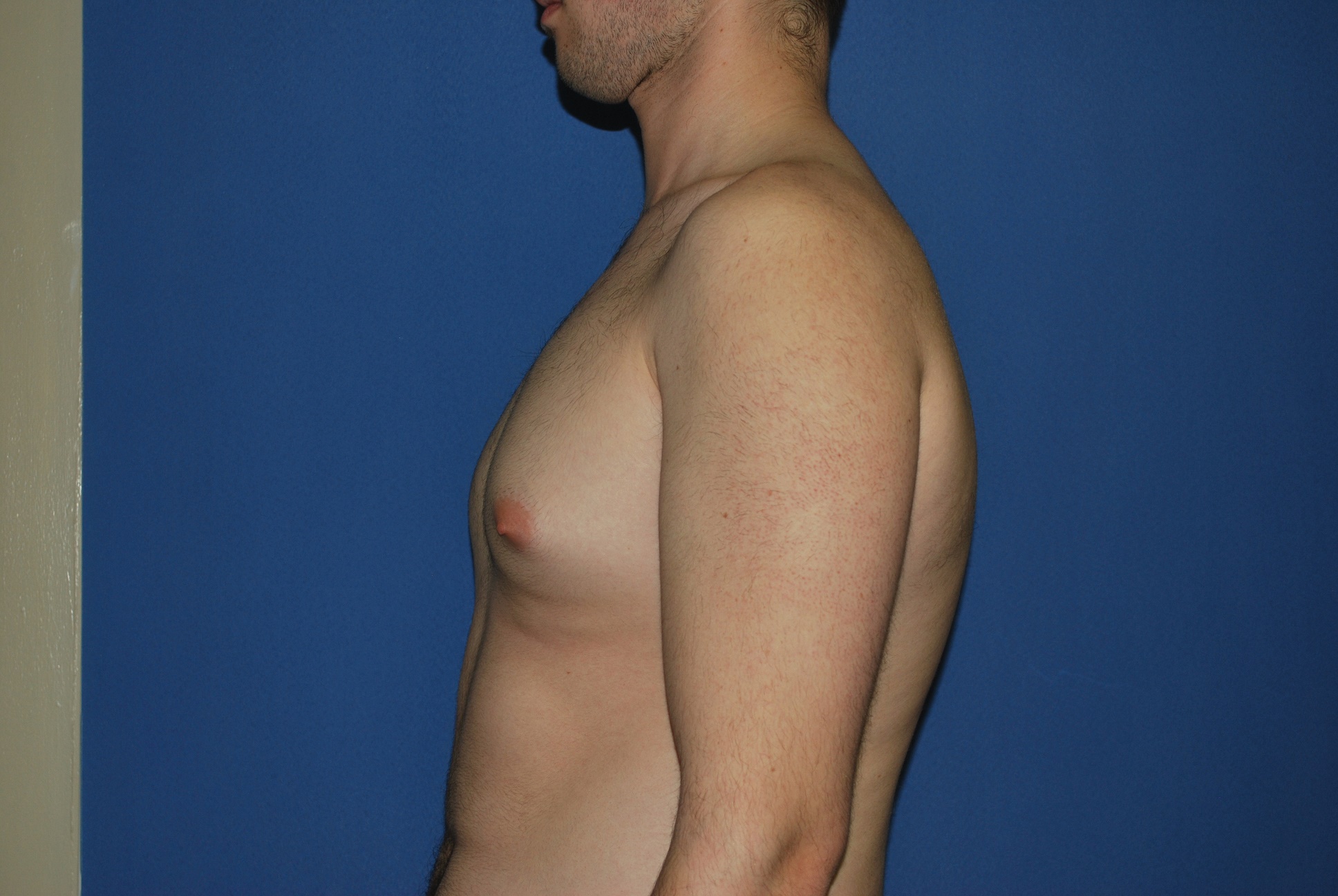 Male Breast Reduction Patient Photo - Case 4897 - before view-1