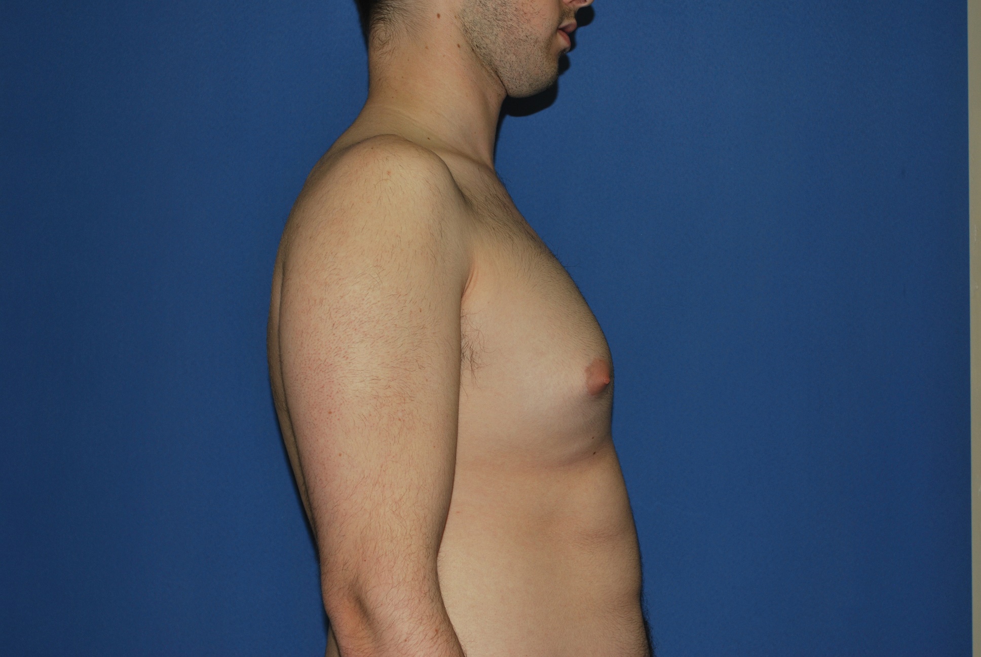 Male Breast Reduction Patient Photo - Case 4897 - before view-3