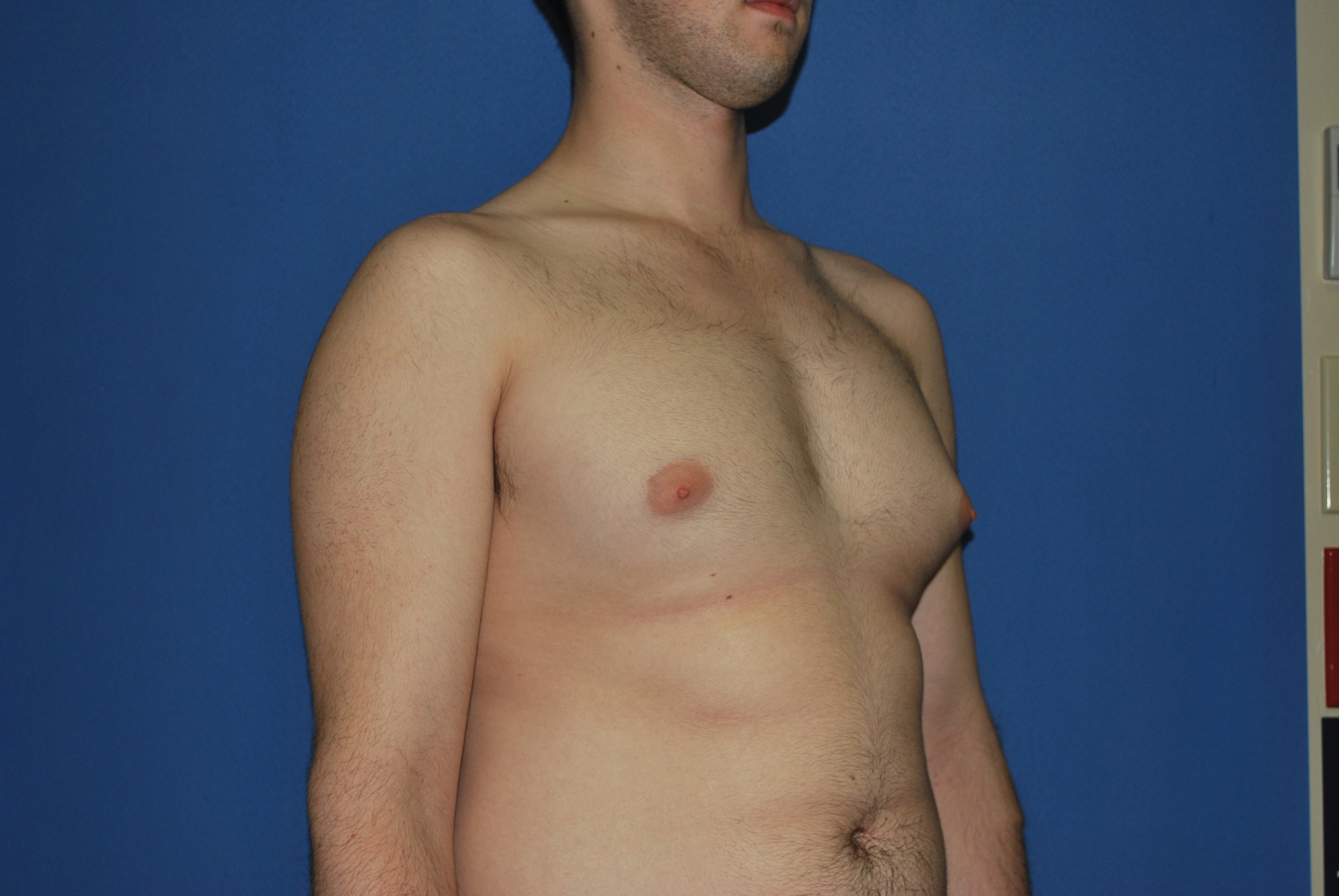 Male Breast Reduction Patient Photo - Case 4897 - before view-4