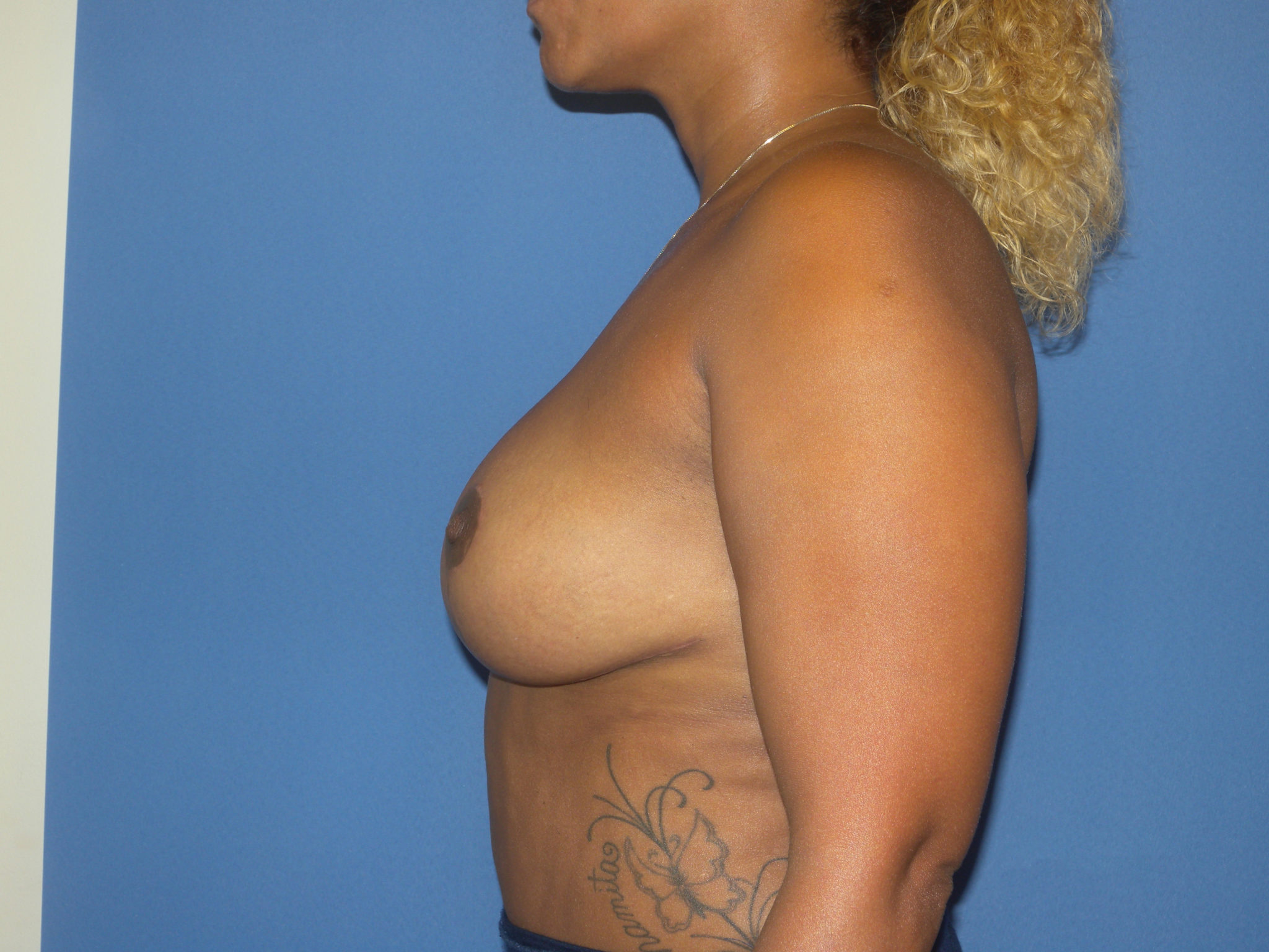 Breast Reduction Patient Photo - Case 4389 - after view-1