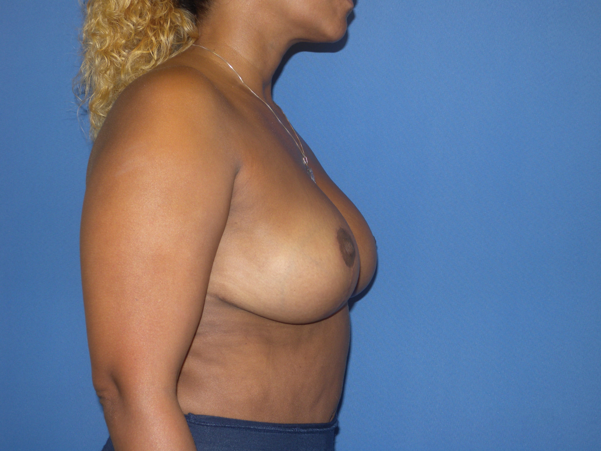 Breast Reduction Patient Photo - Case 4389 - after view-3