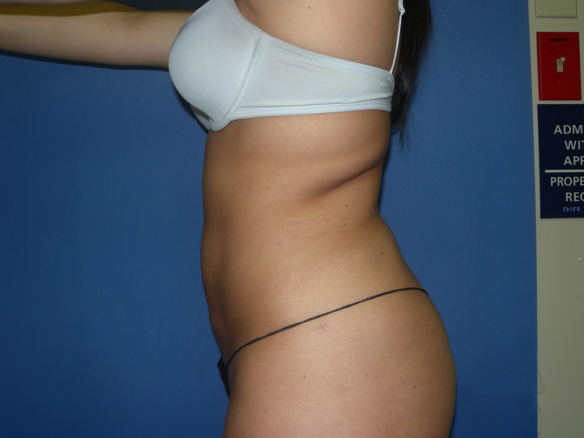 Liposuction Patient Photo - Case 3068 - after view-1