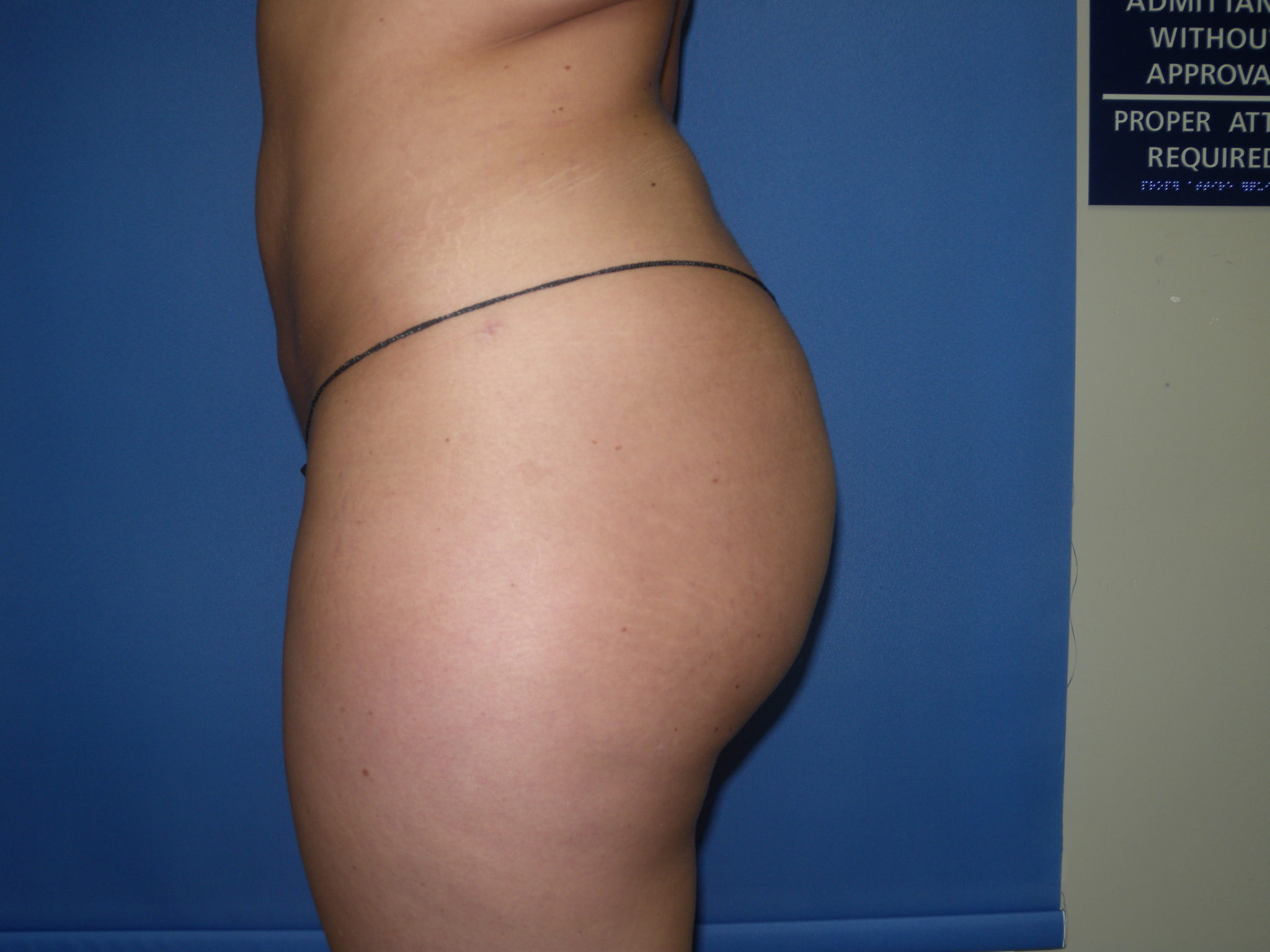 Liposuction Patient Photo - Case 3068 - after view-2