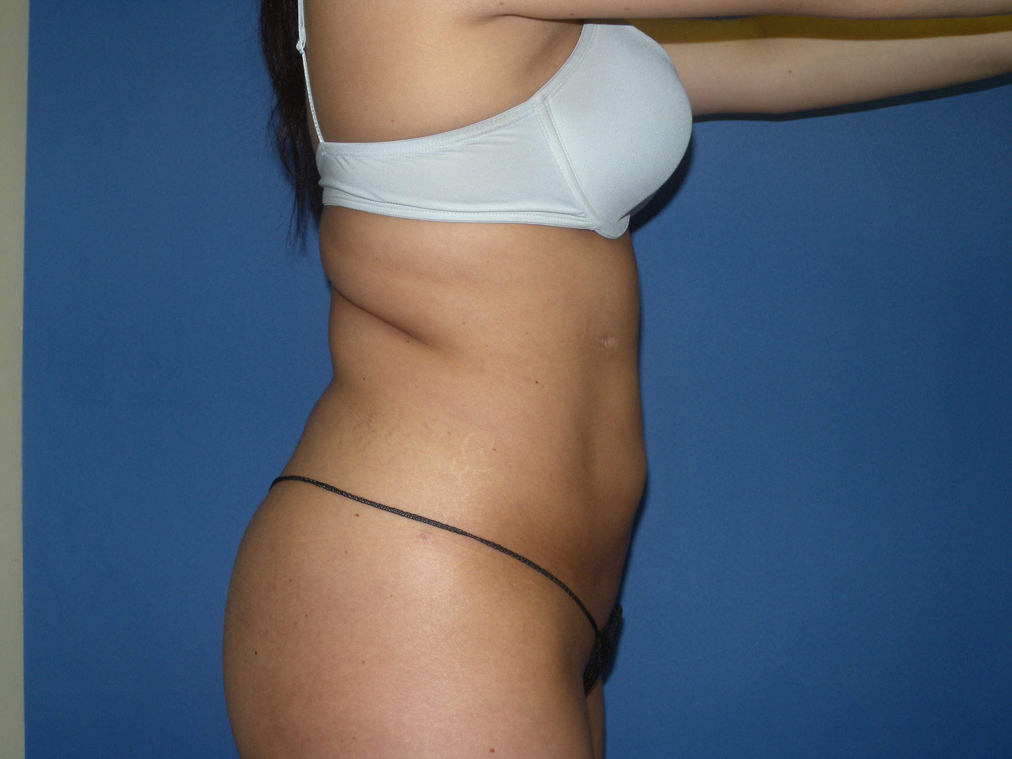 Liposuction Patient Photo - Case 3068 - after view-4