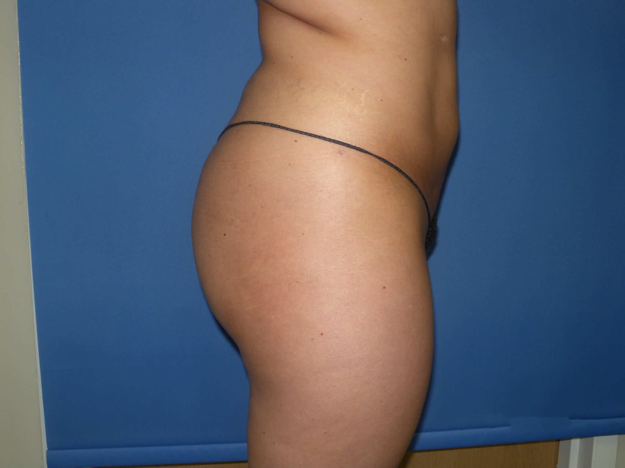 Liposuction Patient Photo - Case 3068 - after view-5