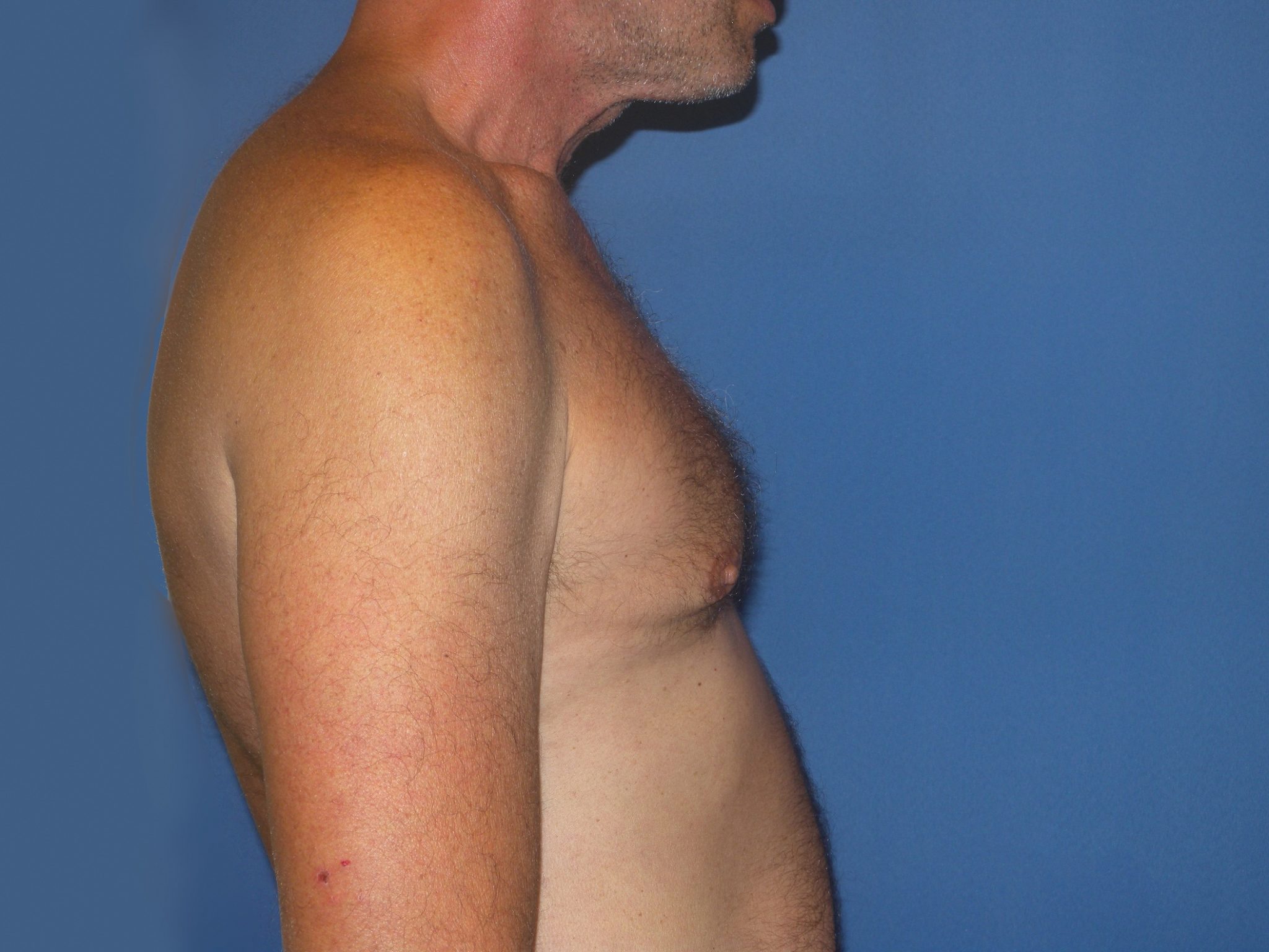Male Breast Reduction Patient Photo - Case 4920 - after view-2