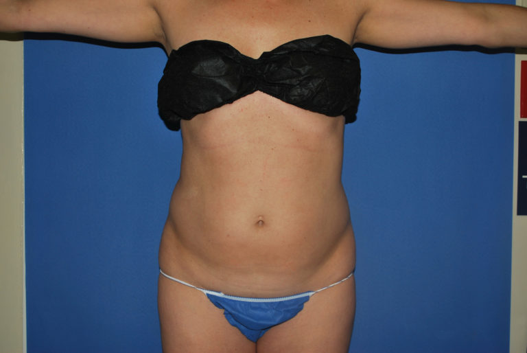 Liposuction - Case 3259 - Before