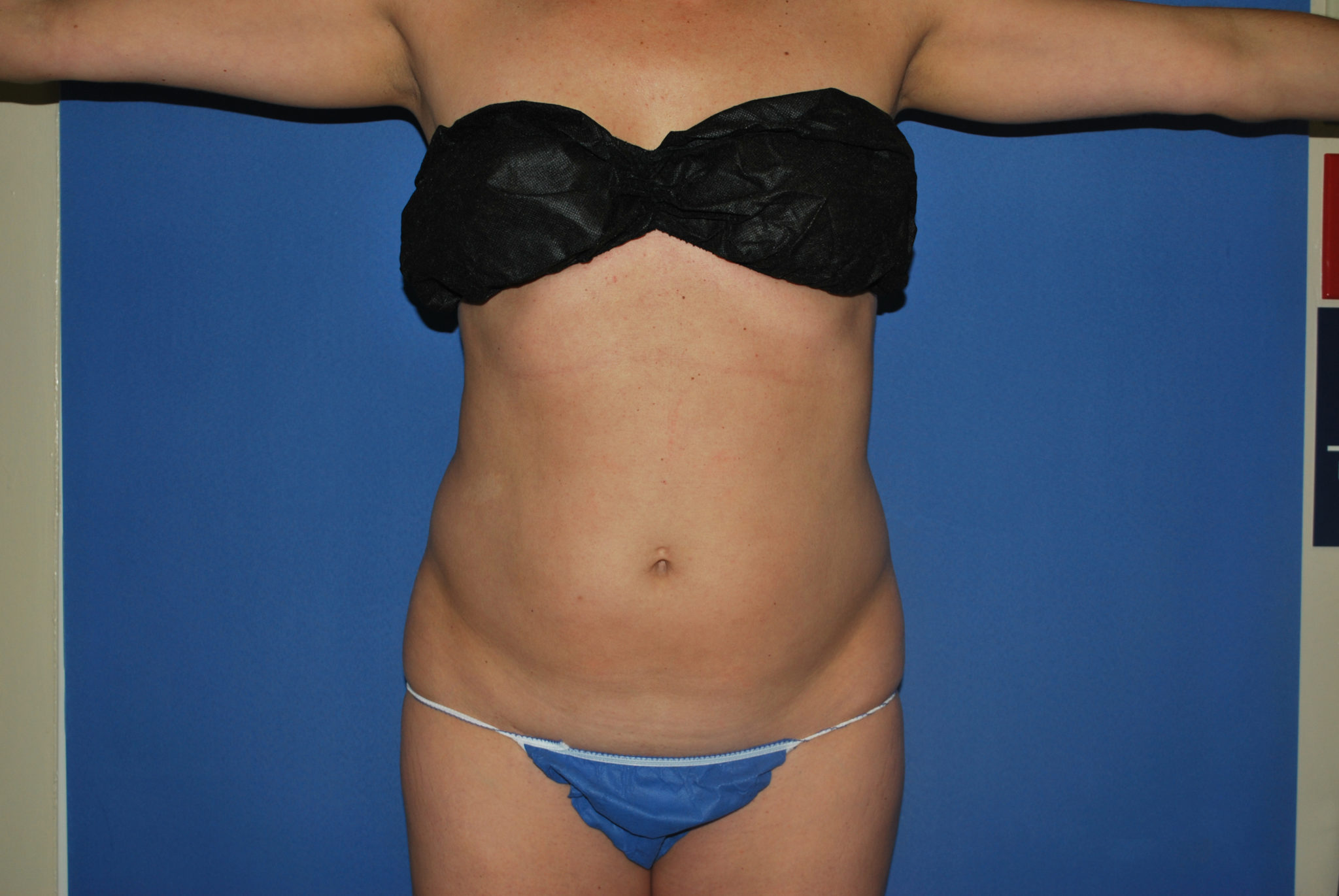 Liposuction Patient Photo - Case 3259 - before view-