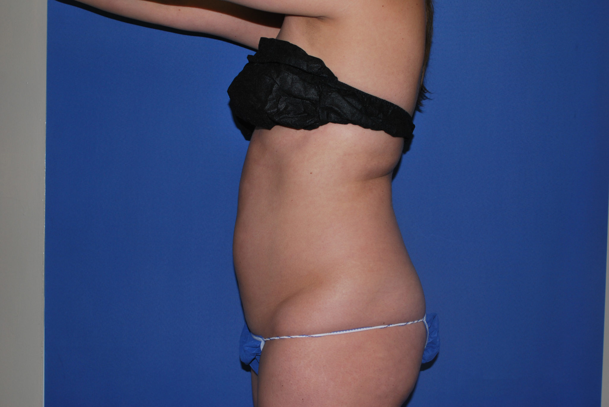 Liposuction Patient Photo - Case 3259 - before view-4