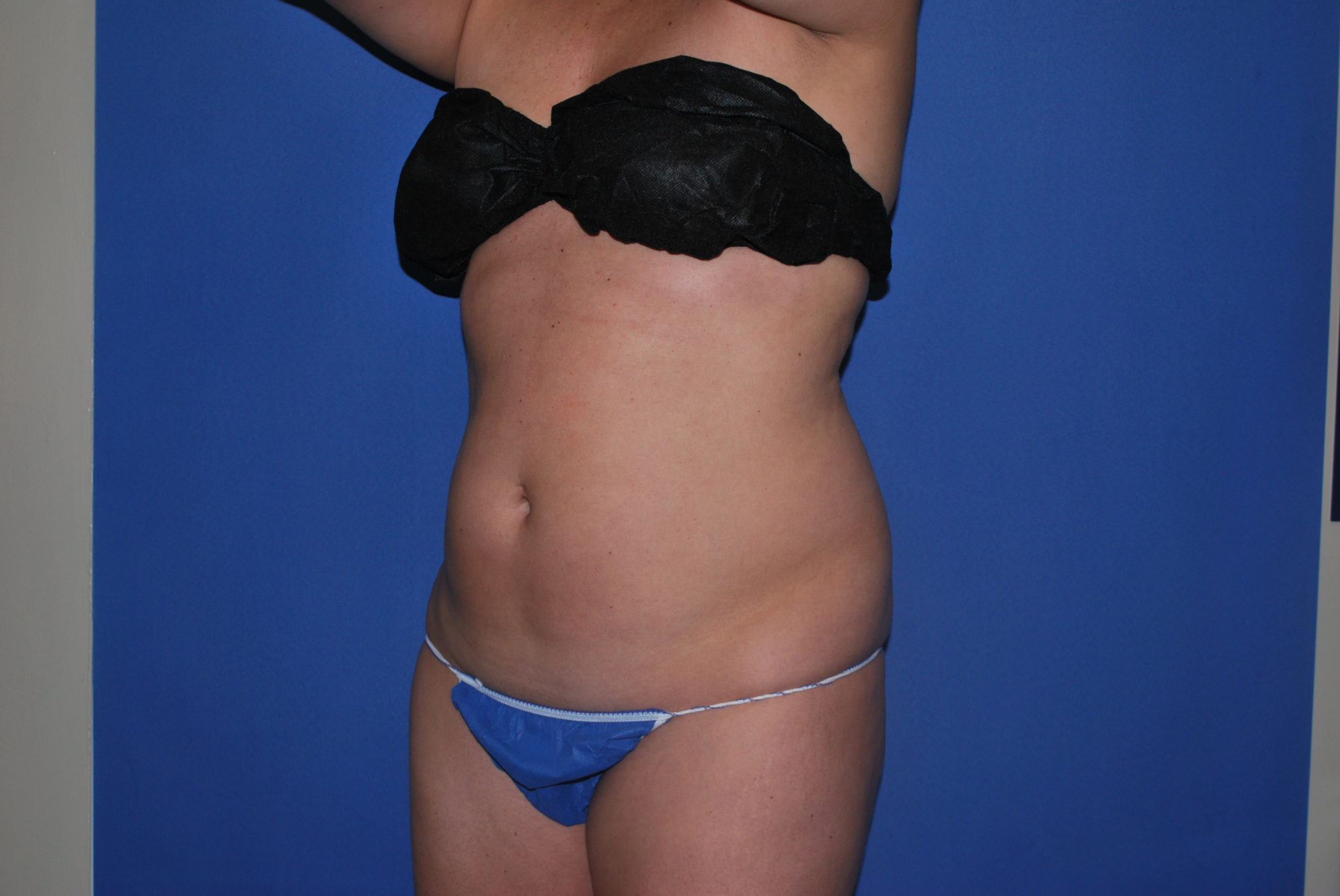 Liposuction Patient Photo - Case 3259 - before view-3