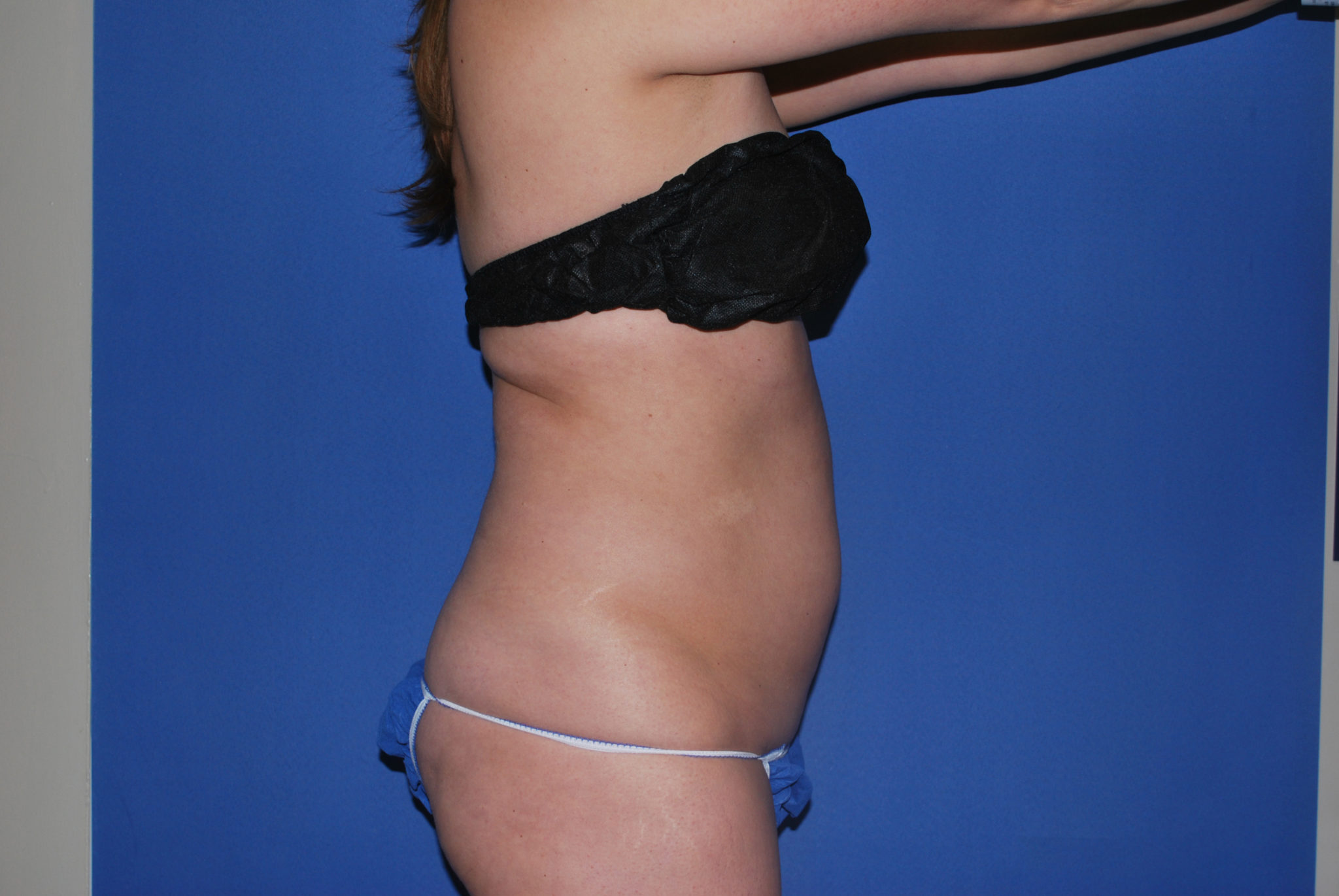 Liposuction Patient Photo - Case 3259 - before view-2