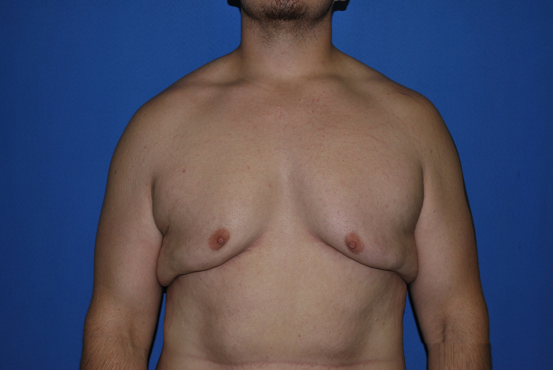 Male Breast Reduction Patient Photo - Case 4198 - before view-0