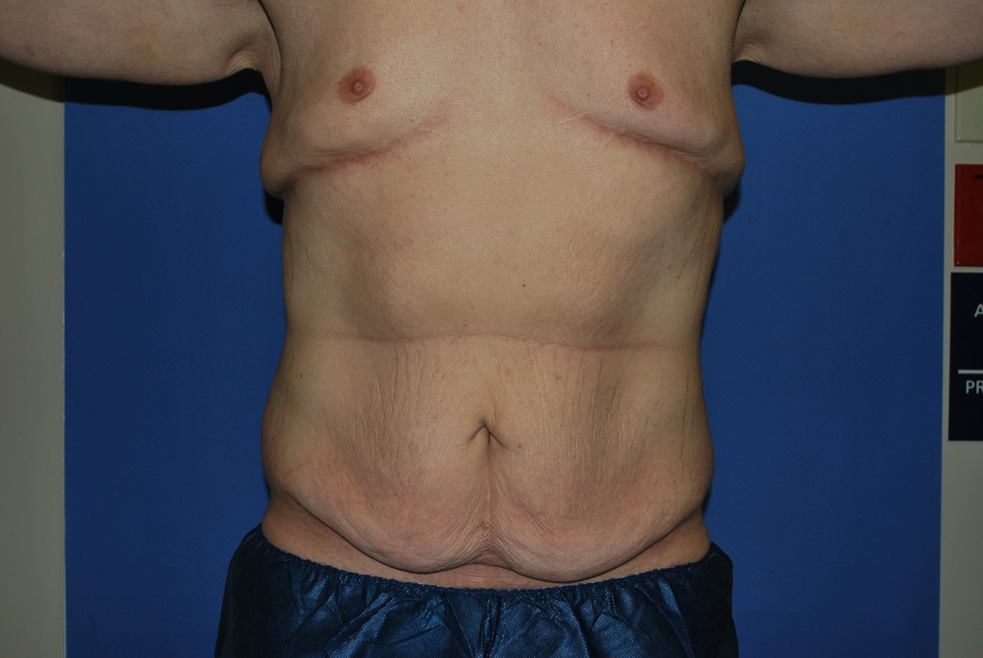 Male Breast Reduction Patient Photo - Case 4198 - before view-1