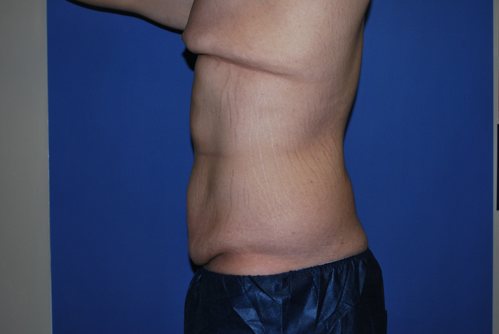 Male Breast Reduction Patient Photo - Case 4198 - before view-2