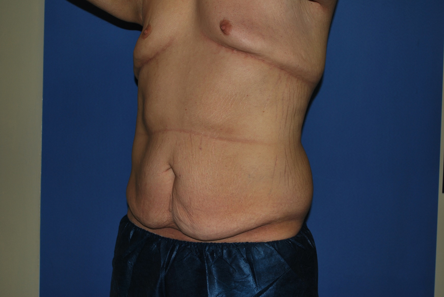 Male Breast Reduction Patient Photo - Case 4198 - before view-3