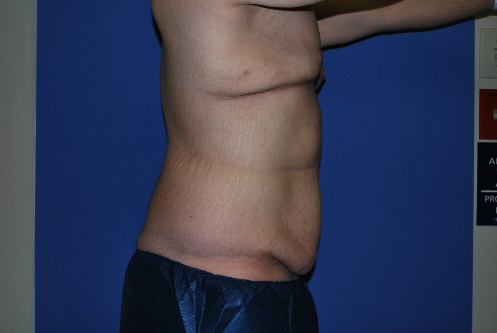 Male Breast Reduction Patient Photo - Case 4198 - before view-4
