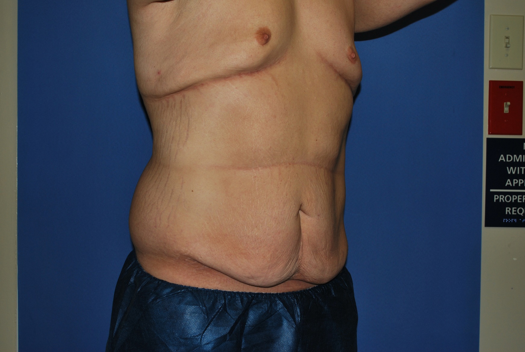 Male Breast Reduction Patient Photo - Case 4198 - before view-5