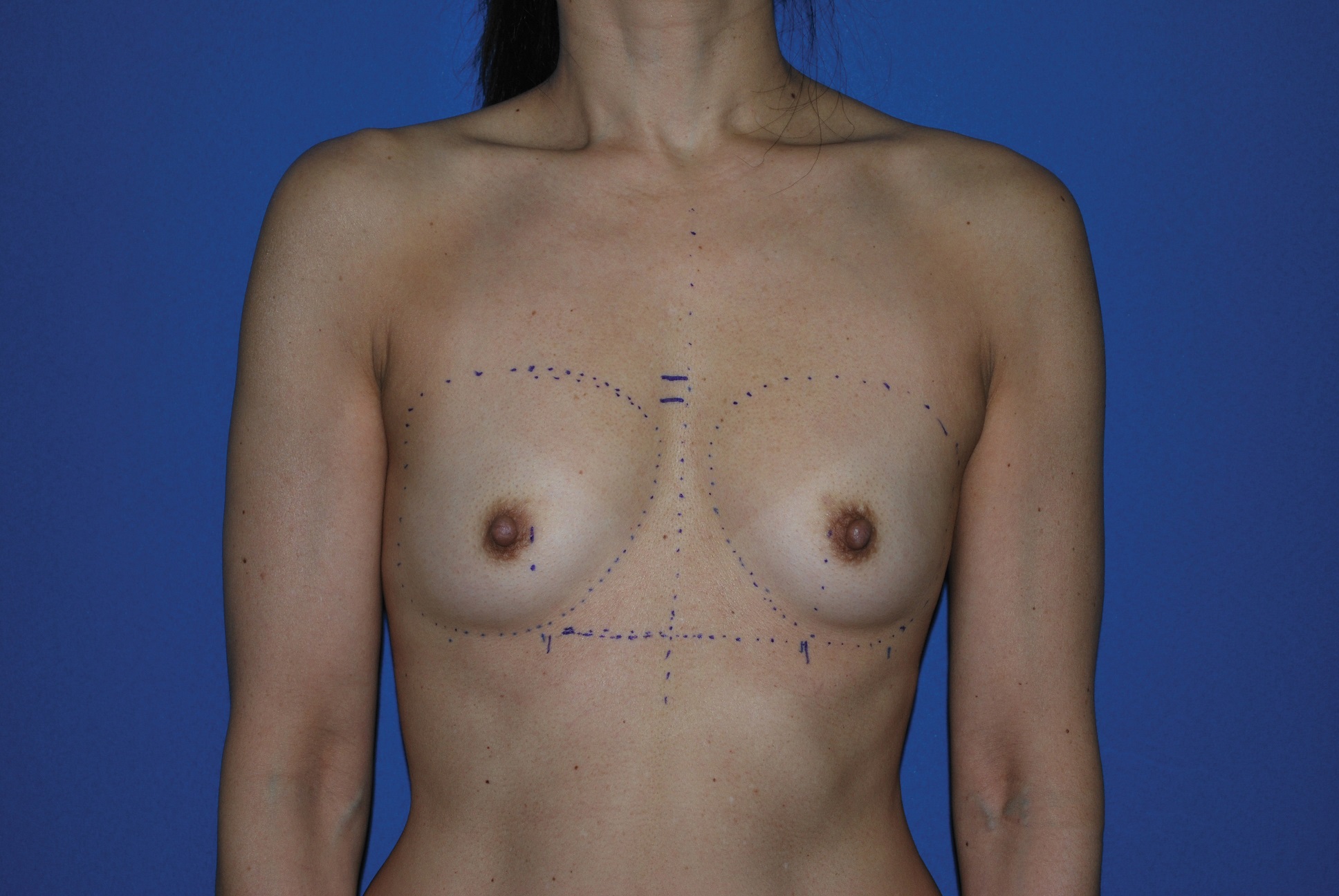 Breast Augmentation Patient Photo - Case 4313 - before view-4