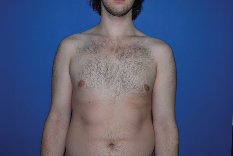 Male Breast Reduction - Case 4897 - After