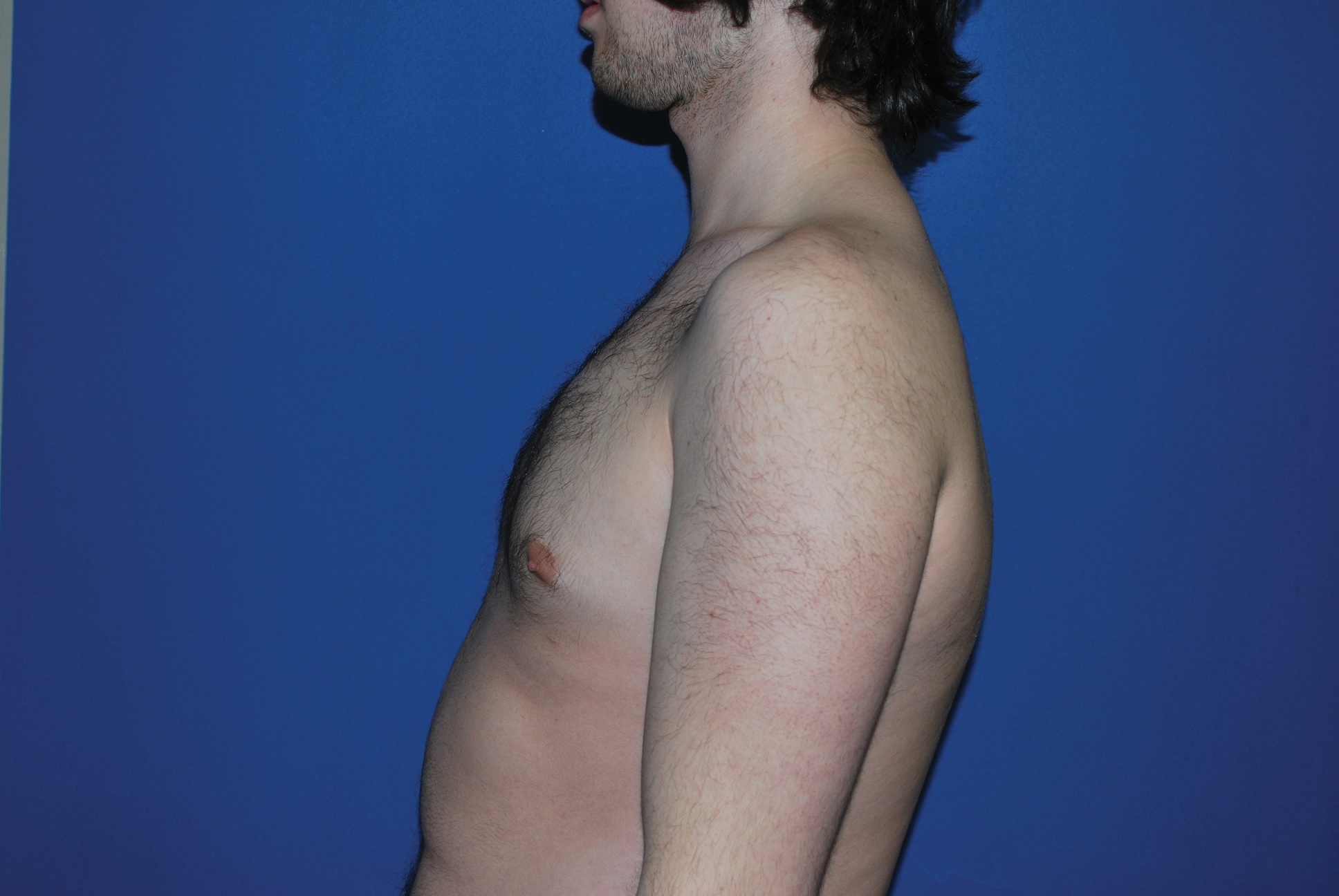 Male Breast Reduction Patient Photo - Case 4897 - after view-1