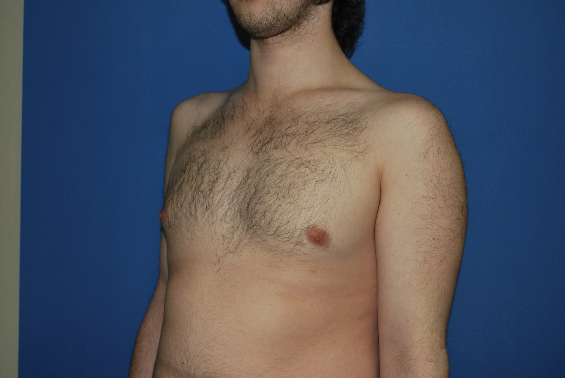 Male Breast Reduction Patient Photo - Case 4897 - after view-2