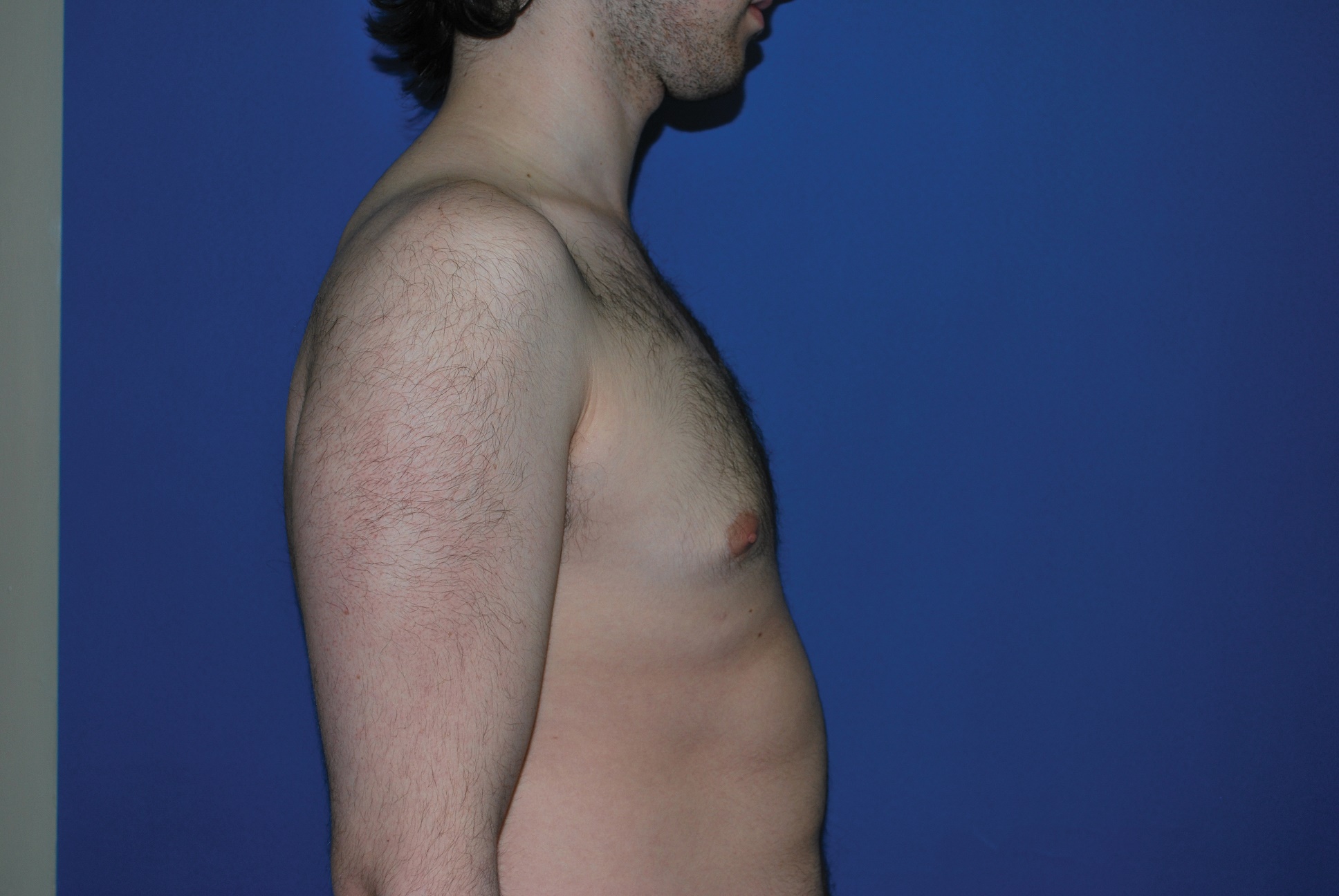 Male Breast Reduction Patient Photo - Case 4897 - after view-3