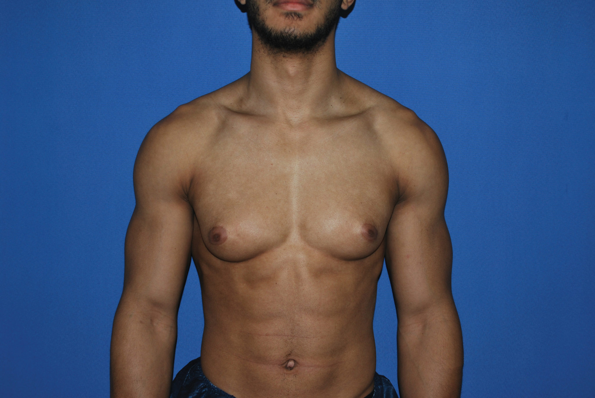Male Breast Reduction Patient Photo - Case 5053 - before view-