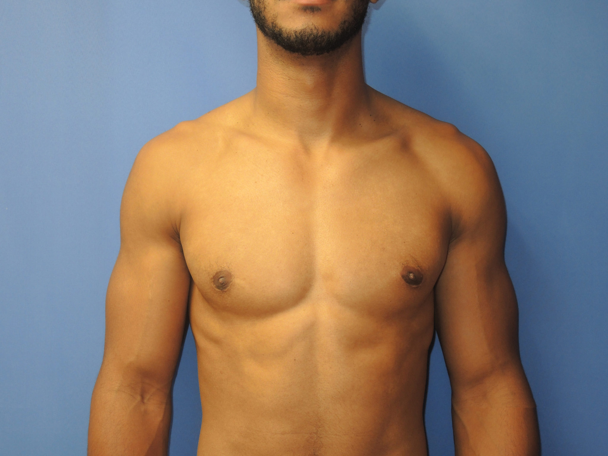 Male Breast Reduction Patient Photo - Case 5053 - after view-0