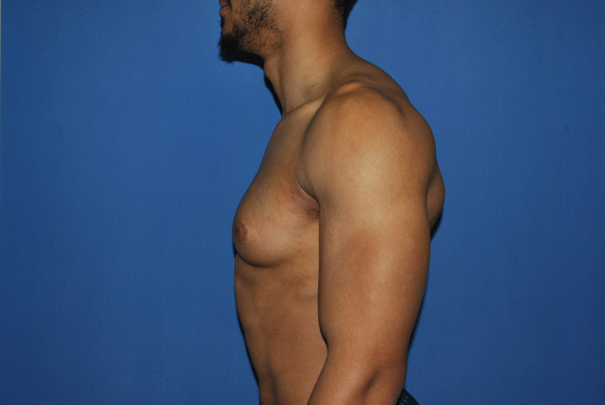 Male Breast Reduction Patient Photo - Case 5053 - before view-1