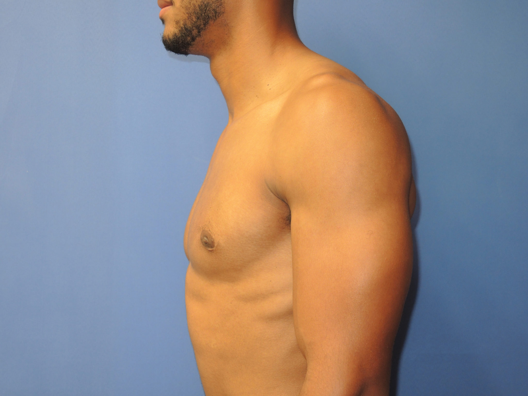 Male Breast Reduction Patient Photo - Case 5053 - after view-1