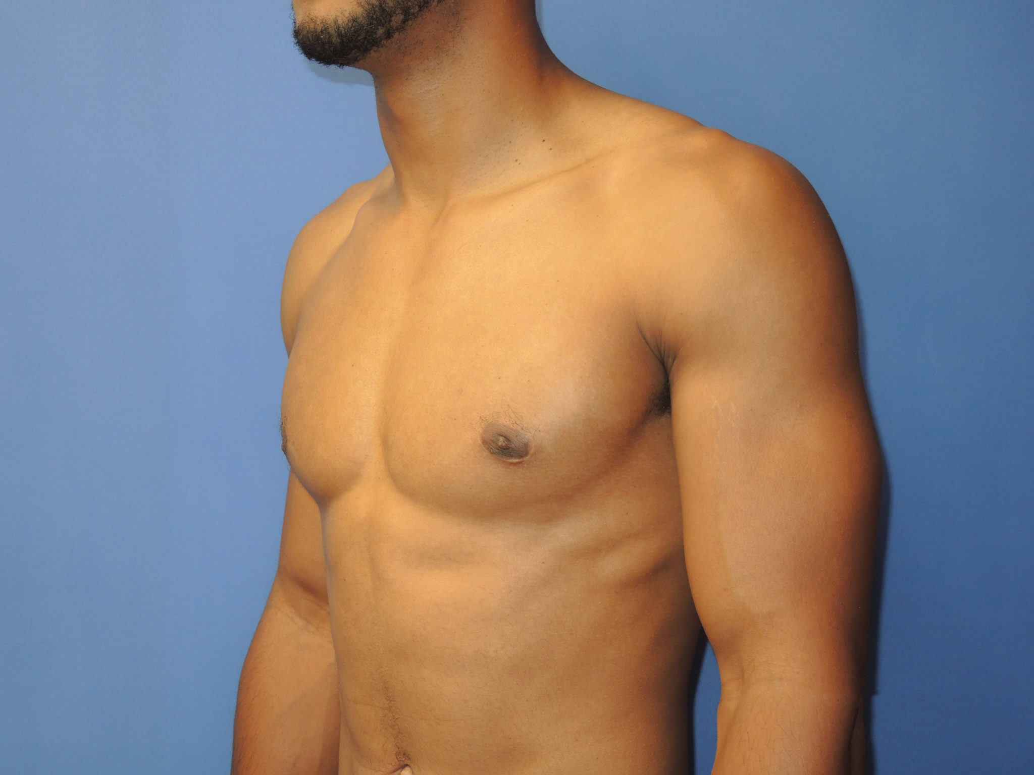 Male Breast Reduction Patient Photo - Case 5053 - after view-2