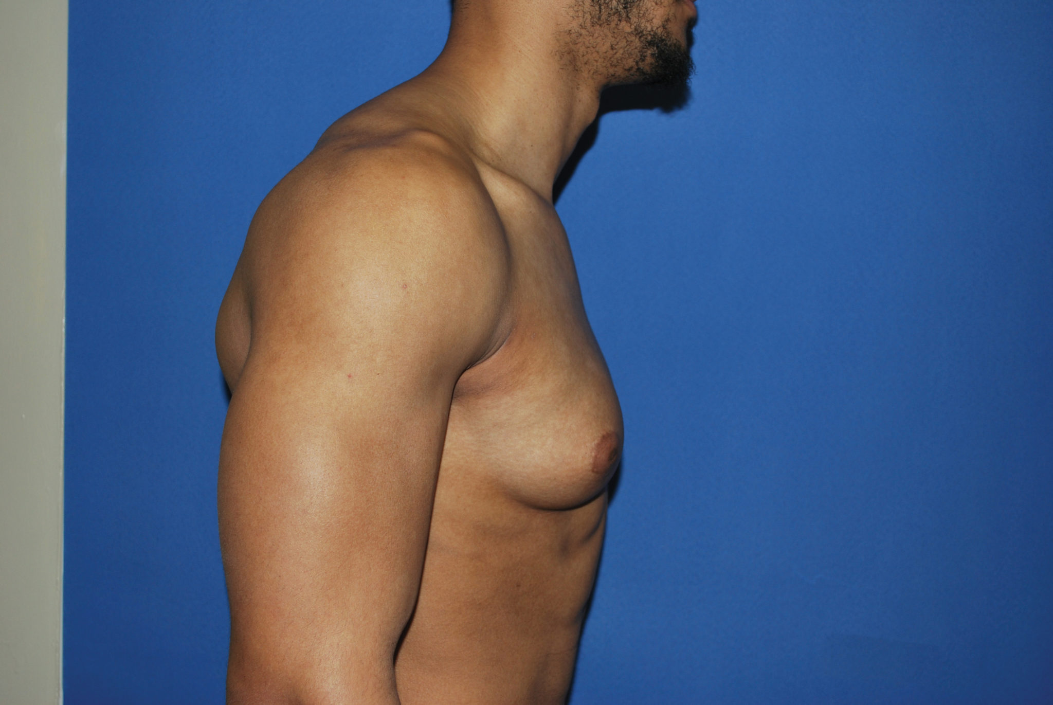 Male Breast Reduction Patient Photo - Case 5053 - before view-3